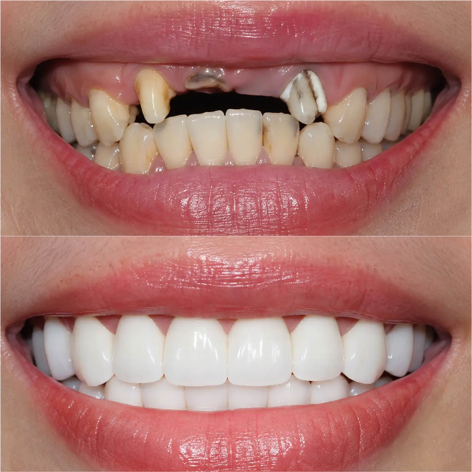 Hình ảnh trước và sau khi làm cầu răng sứ thay răng hàm bị mất tại Nha Khoa Đông Nam – ca 3