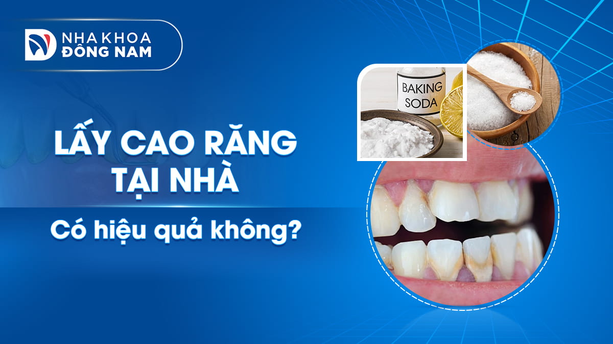 lấy cao răng tại nhà có hiệu quả không