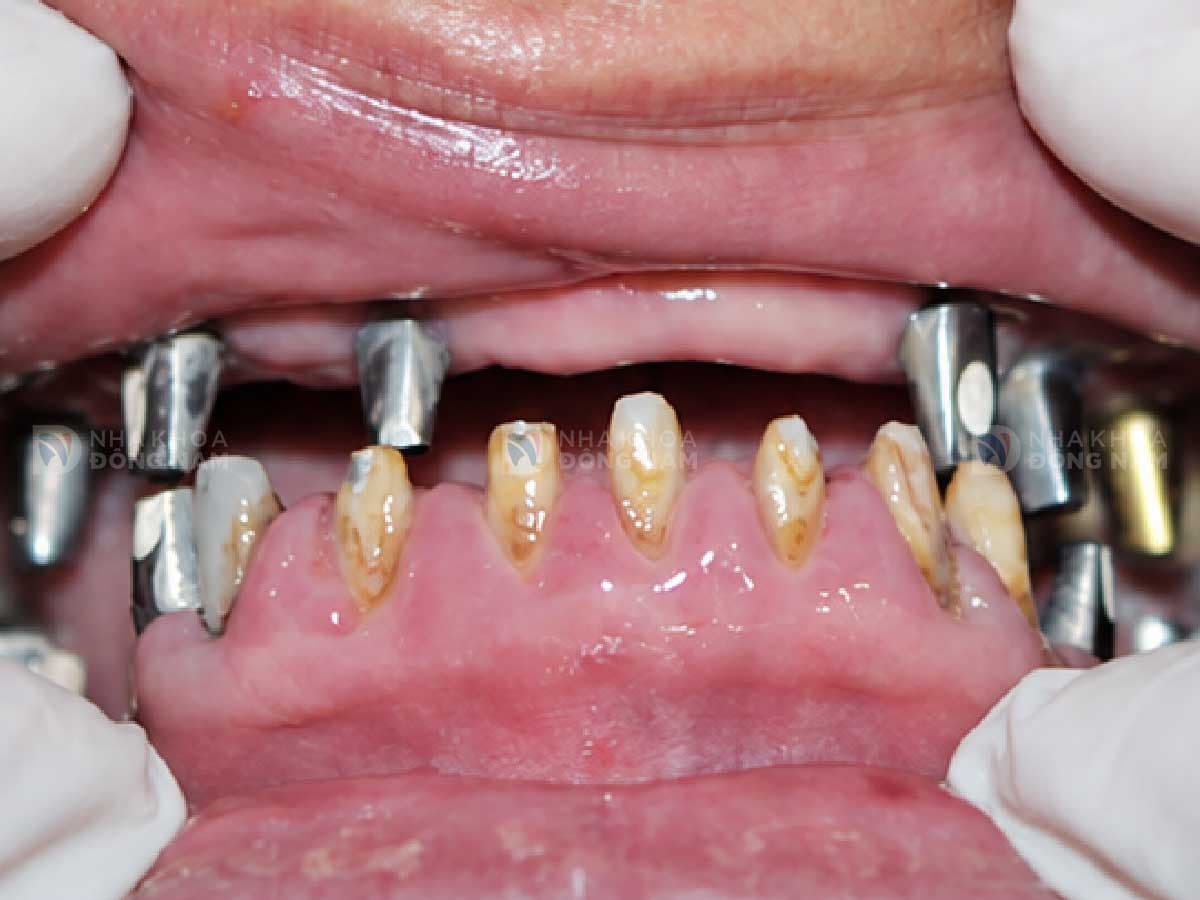 Trước khi trồng răng Implant: [mô tả tình trạng]