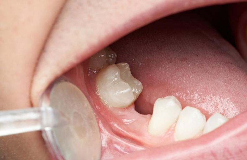 Lựa chọn trụ Implant dựa trên tình trạng xương hàm và vị trí mất răng