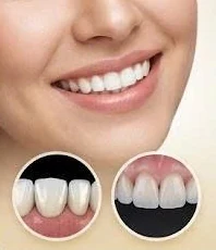 Nụ cười sau khi làm răng sứ thẩm mỹ