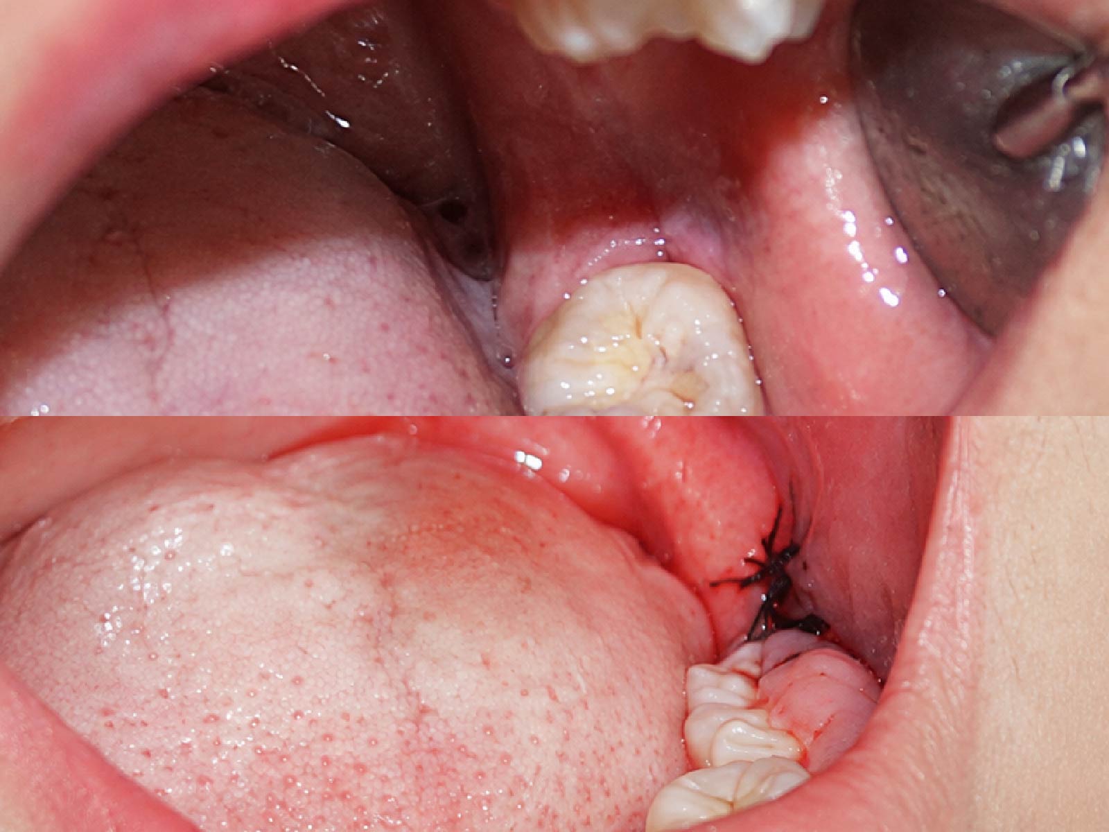 Ca nhổ răng khôn hàm dưới tại Nha Khoa Đông Nam: răng trước khi nhổ (trên) và vết nhổ đã được khâu (dưới)