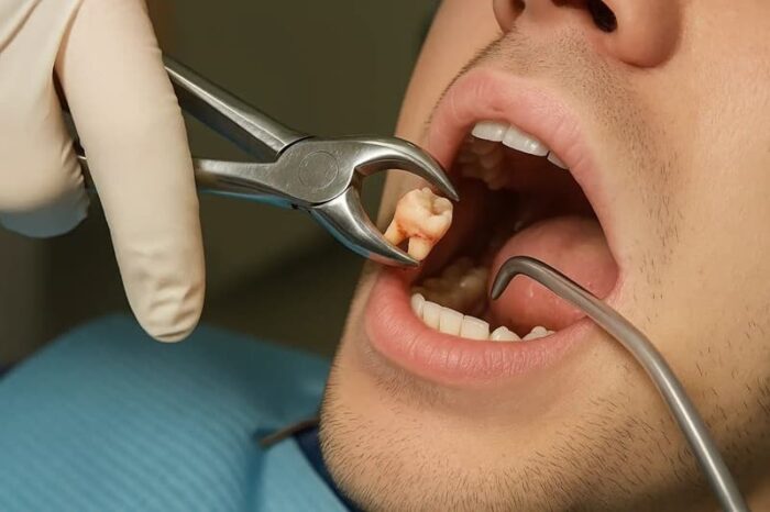 nhổ răng khôn hàm dưới là thủ thuật phổ biến trong nha khoa