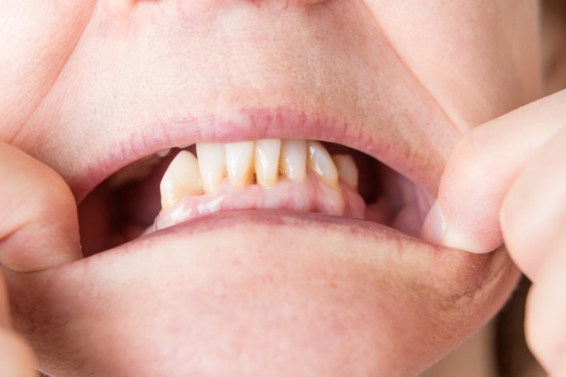 những trường hợp mật độ xương hàm không đủ tiêu chuẩn thực hiện ghép xương