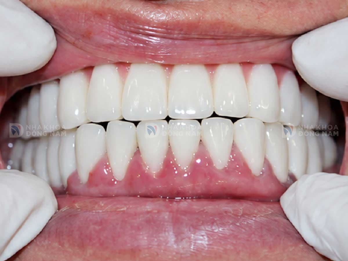 Sau khi trồng răng Implant: [mô tả kết quả]