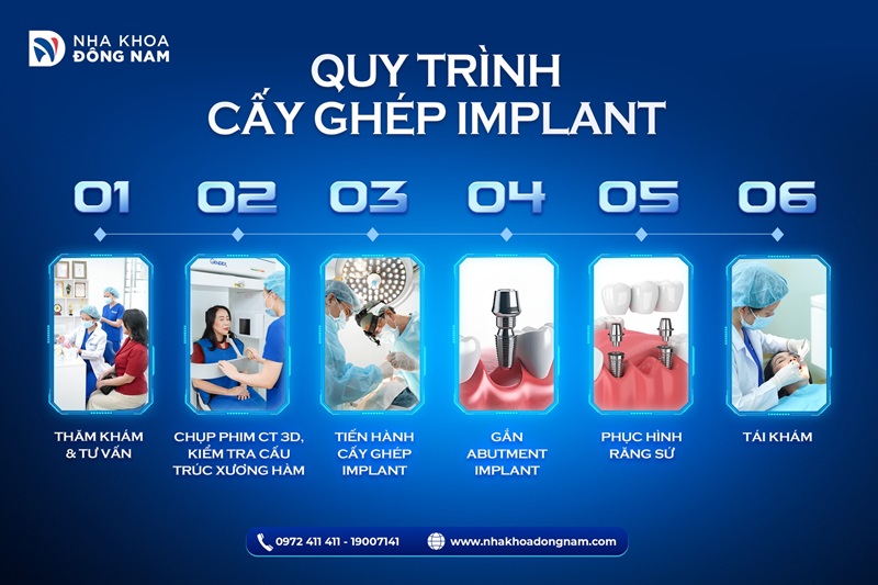 Quy trình cấy ghép Implant tại nha khoa Đông nam