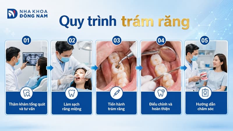 quy trình trám răng chuẩn y khoa
