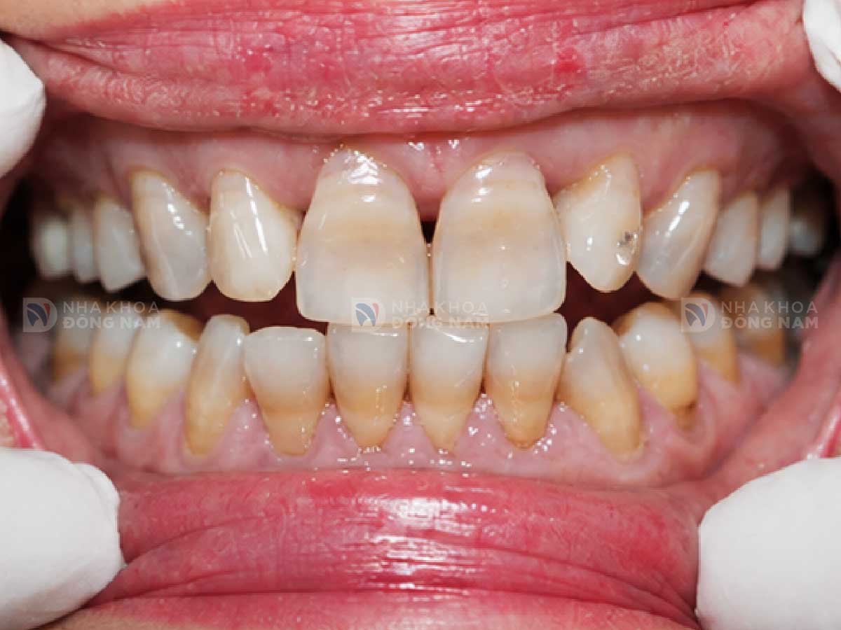 Trước khi bọc răng sứ: [mô tả tình trạng ca 2]