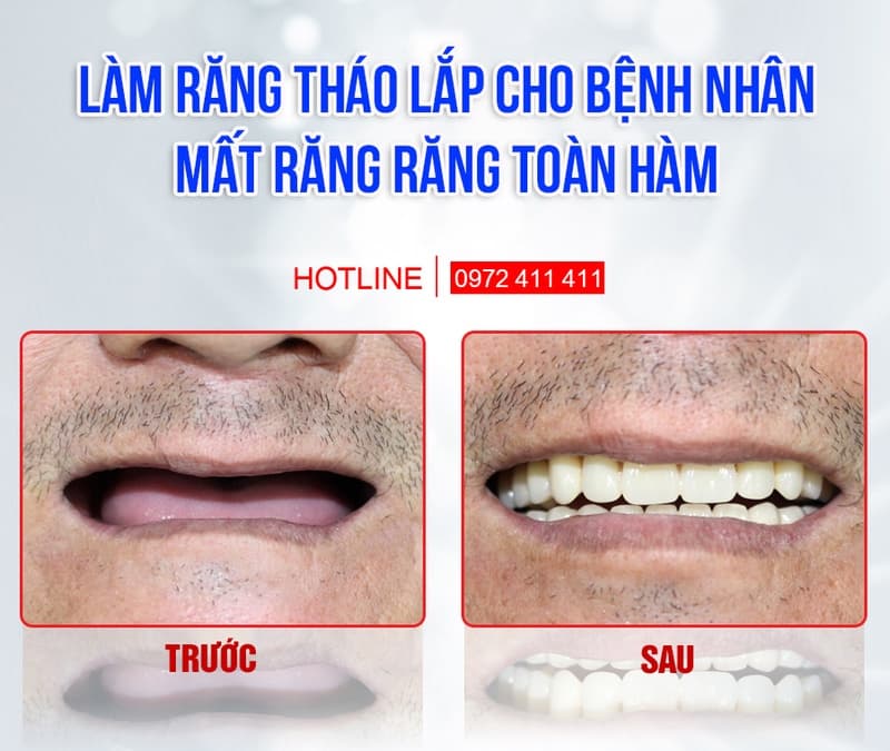Răng giả tháo lắp giúp cải thiện ăn nhai ở mức cơ bản