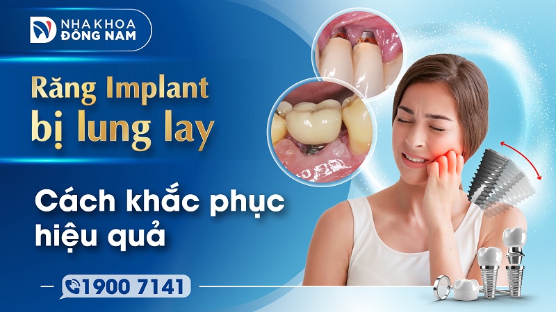 rang implant bi lung lay