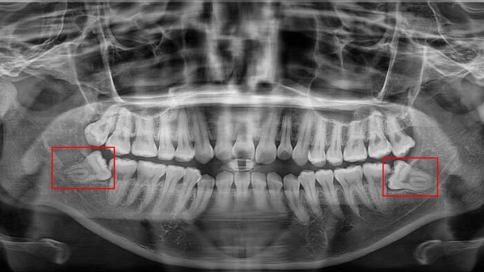 răng khôn hàm dưới nằm ở cuối cung hàm, phía sau răng số 7