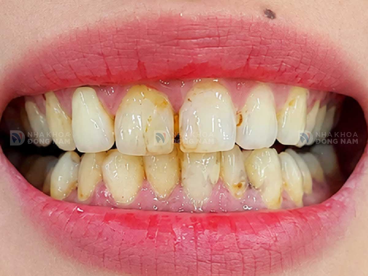Trước khi bọc răng sứ: [mô tả tình trạng ca 1]