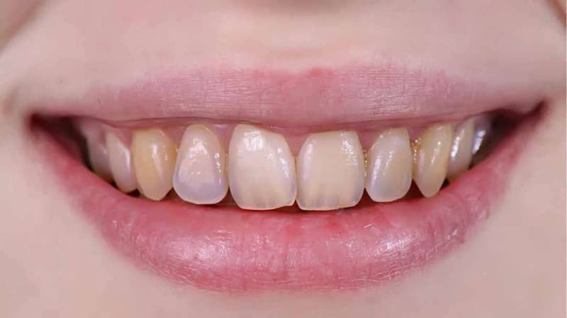 Răng xỉn màu ố vàng nhẹ có thể khắc phục bằng phương pháp tẩy trắng