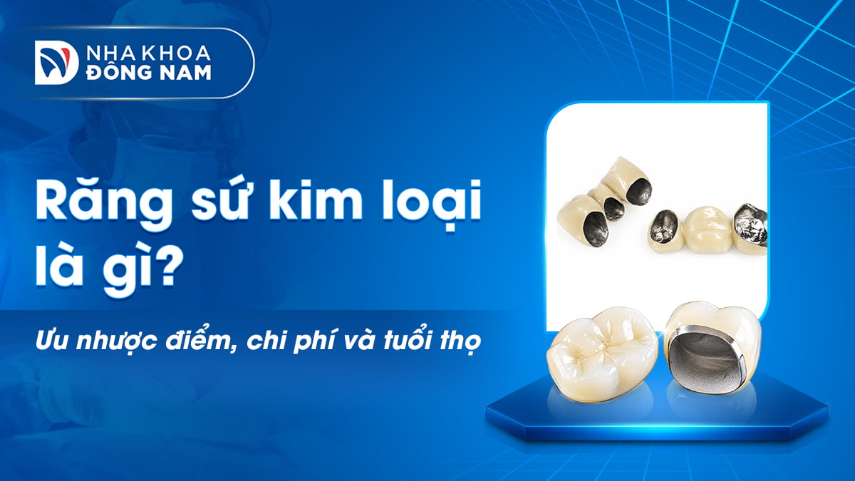 răng sứ kim loại ưu nhược điểm chi phí và tuổi thọ