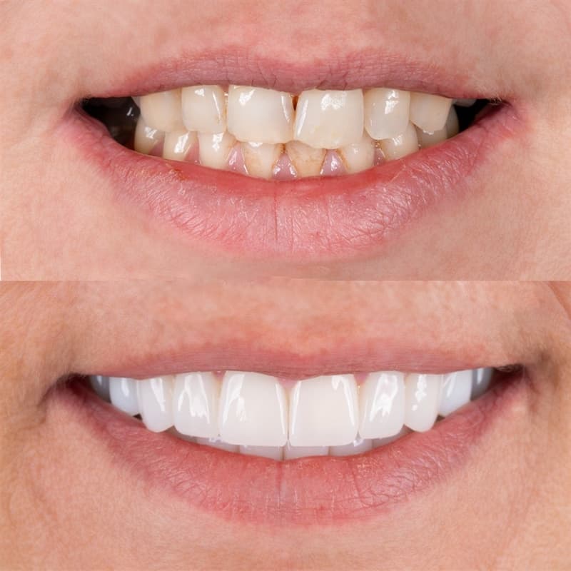 răng sứ orodent mang lại thẩm mỹ tự nhiên cao