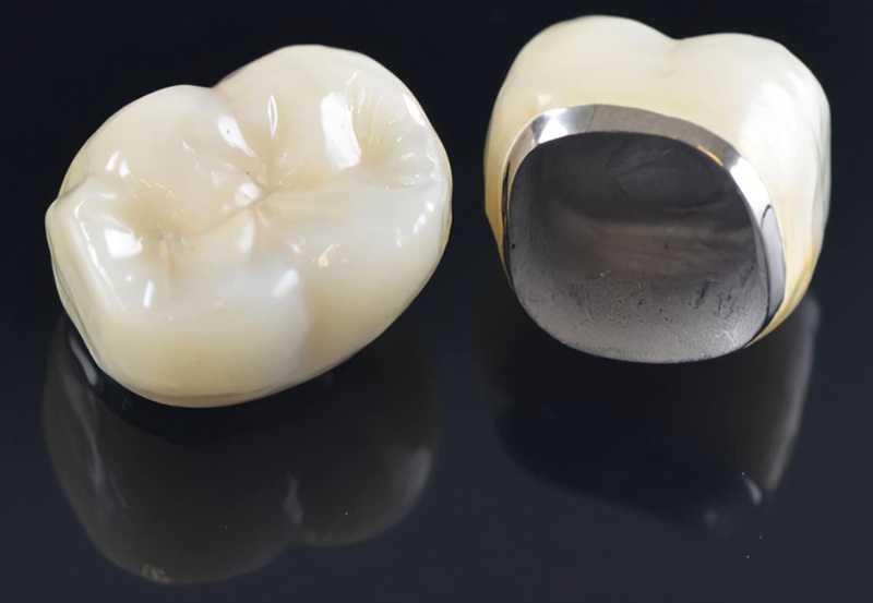 răng sứ titan có phần khung sườn được chế tác từ hợp kim titan
