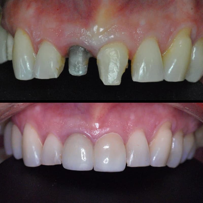 răng sứ titan giúp cải thiện chức năng ăn nhai và thẩm mỹ