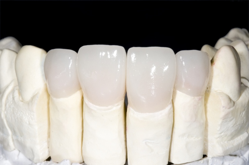 răng sứ zirconia là thuộc dòng răng toàn sứ cao cấp