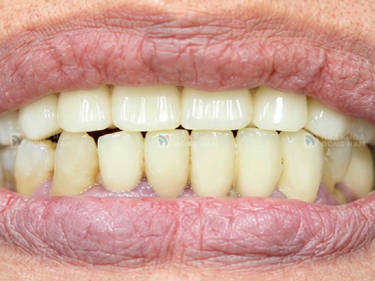 Sau khi trồng răng Implant răng cửa: [mô tả kết quả]