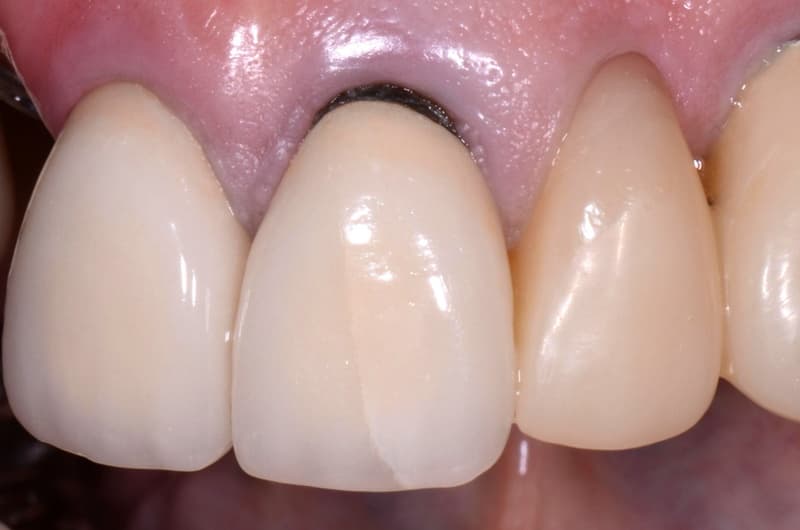 sau một thời gian sử dụng răng sứ titan gặp tình trạng đen viền nướu