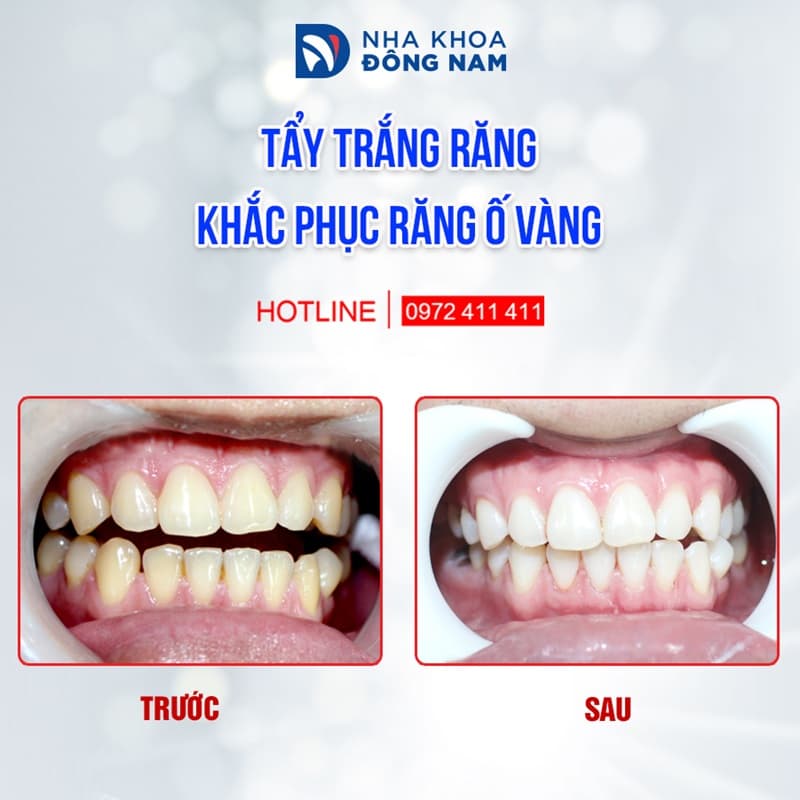Nha Khoa Đông Nam ứng dụng phương pháp tẩy trắng hiện đại giảm ê buốt