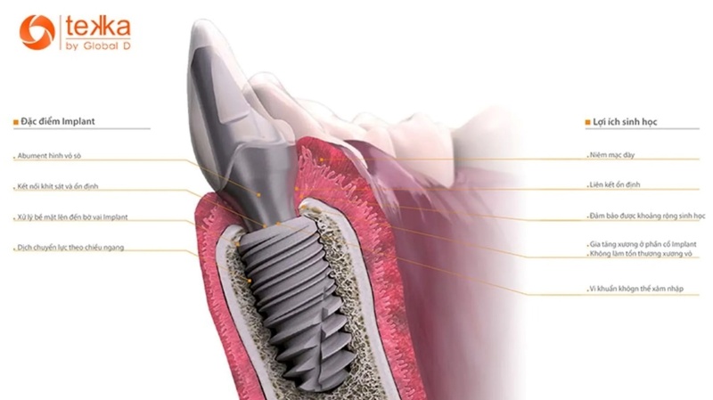 Thiết kế trụ Implant tekka nhiều ưu điểm đặc biệt