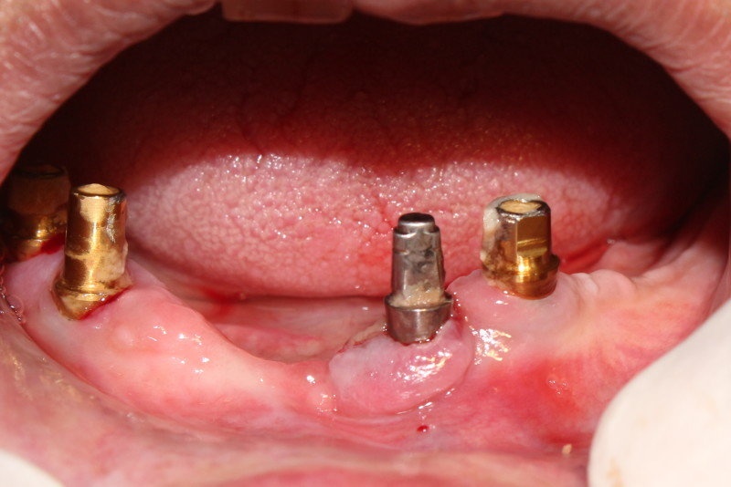 Tình trạng viêm nhiễm Implant sau khi cấy ghép