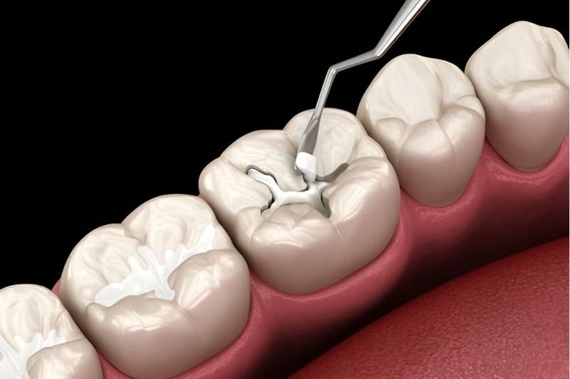 Trám răng là kỹ thuật sử dụng vật liệu trám bù lại phần mô răng bị mất