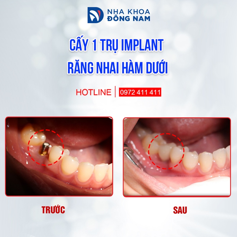 Trồng răng Implant cho trường hợp mất răng riêng lẻ