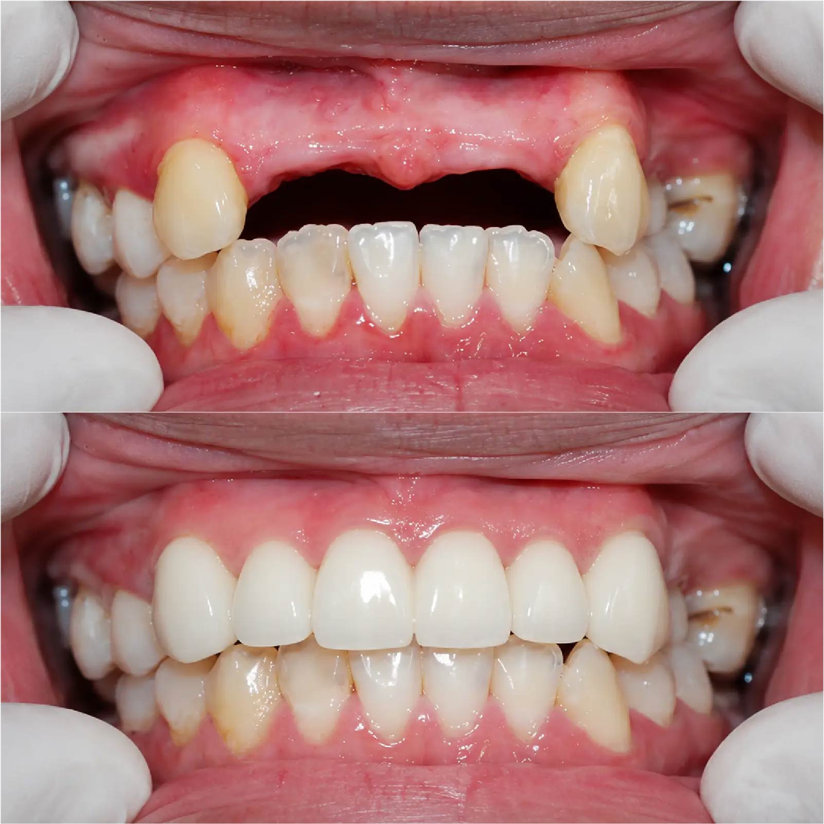 Hình ảnh trước và sau khi làm cầu răng sứ thay cầu răng cũ bị hở tại Nha Khoa Đông Nam – ca 4