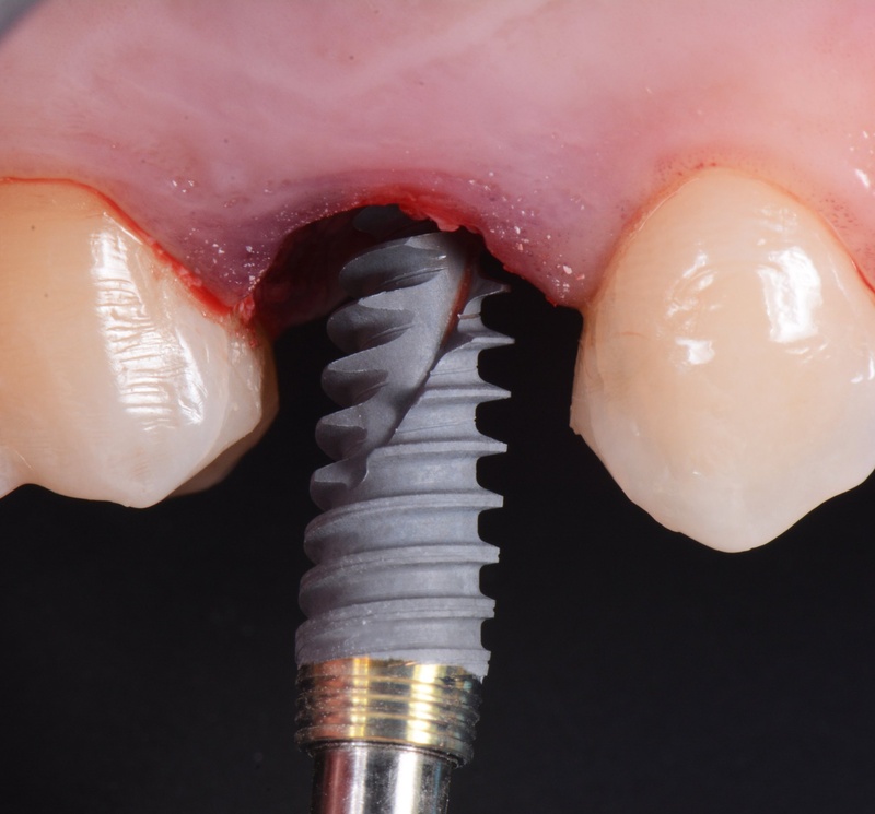 tru implant nobel tang ty le thanh cong ke ca nhung truong hop xuong yeu