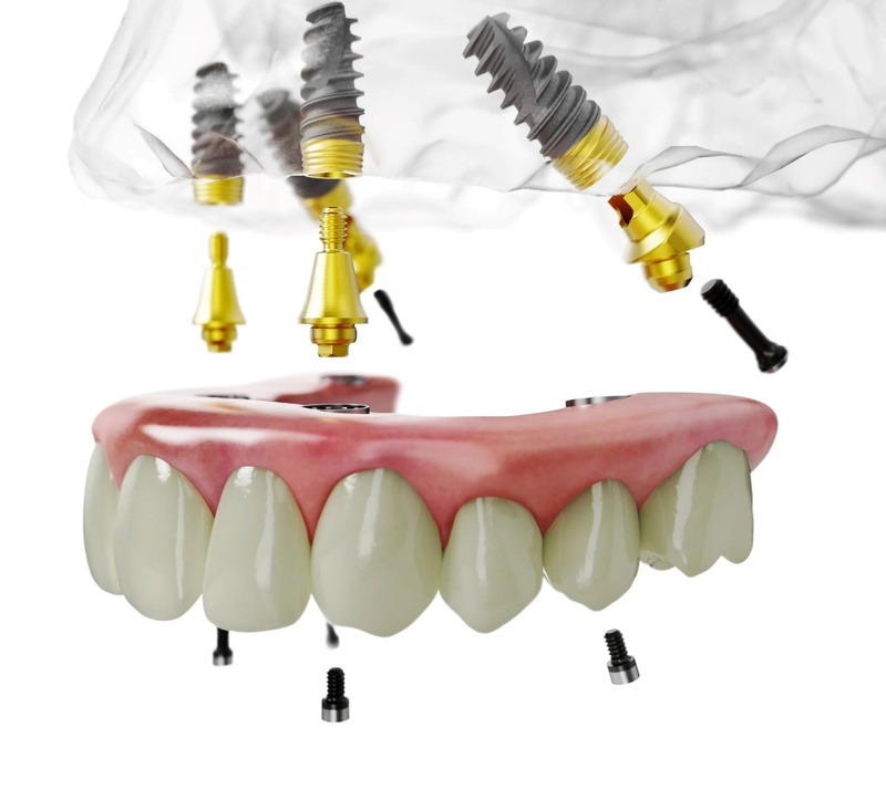 trụ implant nobel thích hợp cho trường hợp trồng all on 4