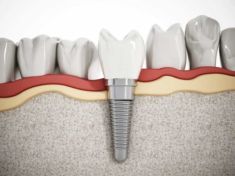trụ implant pháp tích hợp xương tốt