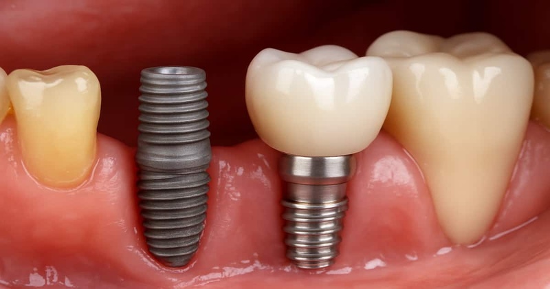Trụ Implant tekka có khả năng tích hợp tốt với xương hàm