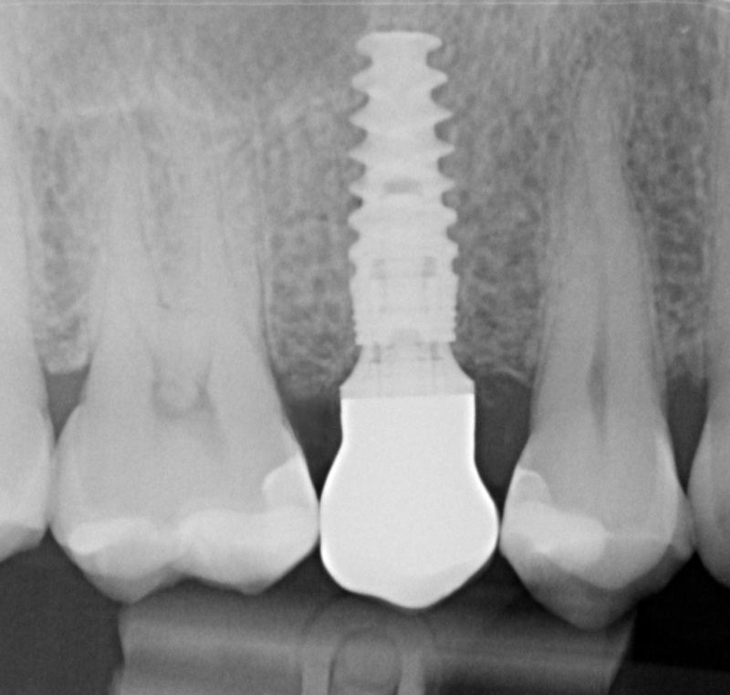 trụ implant ứng dụng đa dạng cho nhiều trường hợp mất răng