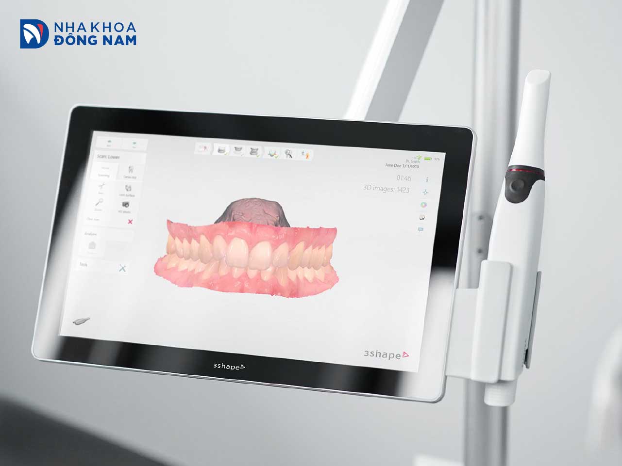 Máy quét trong miệng 3Shape TRIOS hiển thị dấu răng 3D