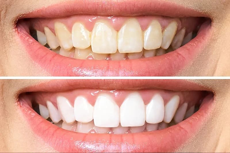 Tẩy trắng giúp răng trắng sáng hơn so với màu răng ban đầu