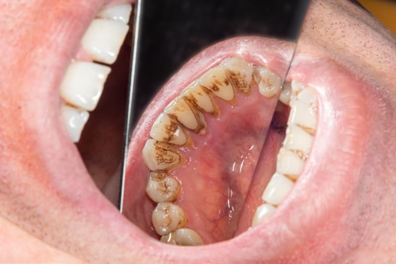 vôi răng là mảng bám cứng chắc không thể tự ý lấy tại nhà